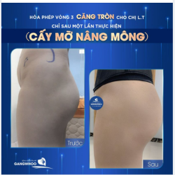 HÓA PHÉP VÒNG 3 CĂNG TRÒN CHO CHỊ L.T NHỜ CẤY MỠ NÂNG MÔNG