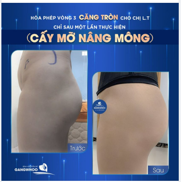 HÓA PHÉP VÒNG 3 CĂNG TRÒN CHO CHỊ L.T NHỜ CẤY MỠ NÂNG MÔNG