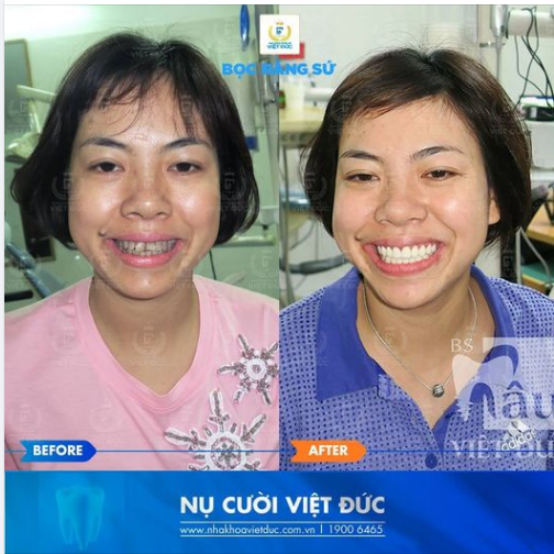 Hồi sinh nụ cười, thăng hạng tự tin sau thẩm mỹ răng sứ