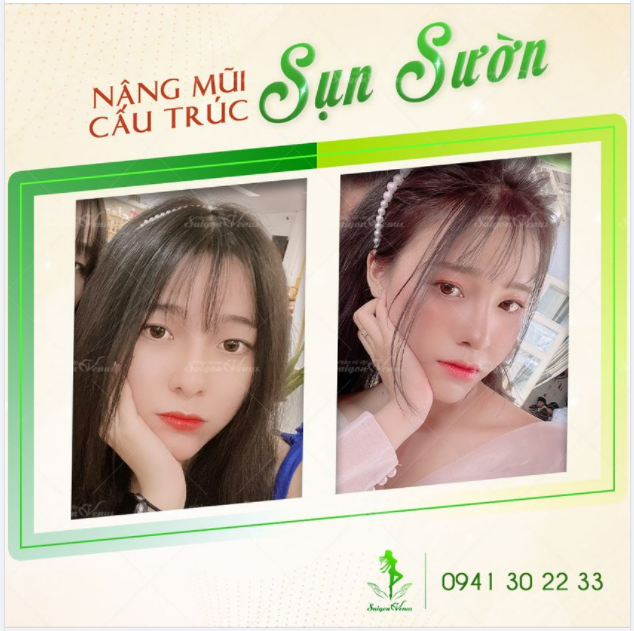 HOT GIRL NY NY KHOE DÁNG MŨI MỚI SAU KHI NÂNG CẤP MŨI SỤN SƯỜN