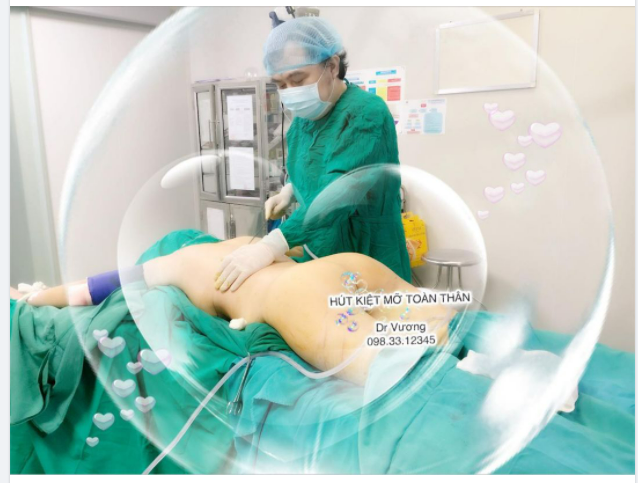 HÚT KIỆT MỠ với Dr Vương