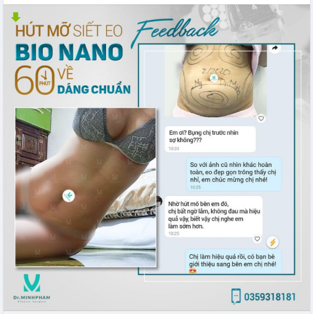 HÚT MỠ BỤNG BIO NANO CÓ THỰC SỰ HIỆU QUẢ?