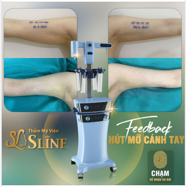 HÚT MỠ CÁNH TAY. Đẹp ngay chỉ sau 1 lần thực hiện