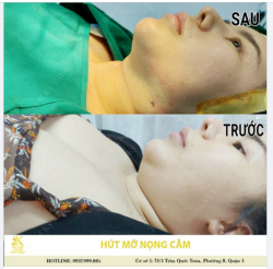 Hút mỡ nọng cằm là một trong những dịch vụ phẫu thuật thẩm mỹ mang lại hiệu ứng khuôn mặt hiệu quả.