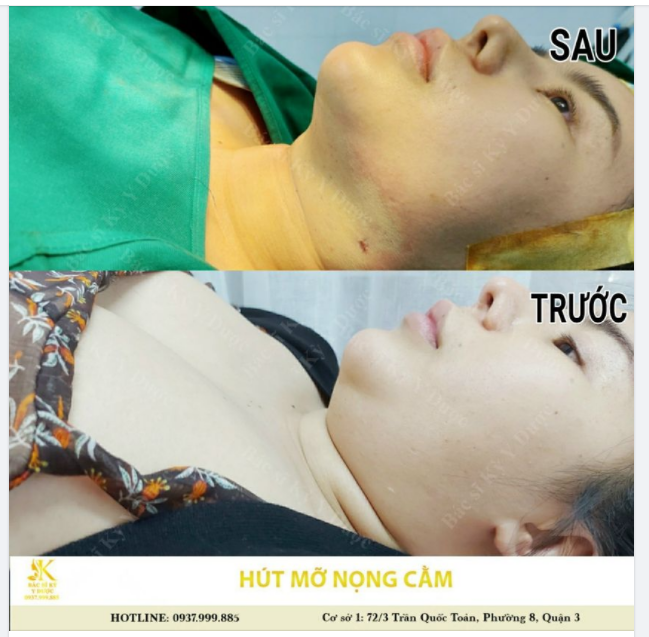 Hút mỡ nọng cằm là một trong những dịch vụ phẫu thuật thẩm mỹ mang lại hiệu ứng khuôn mặt hiệu quả.