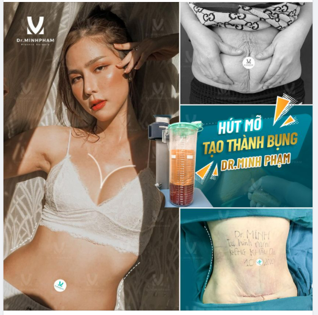 HÚT MỠ TẠO THÀNH BỤNG MINI EO PHẲNG LÌ – MIX GÌ CŨNG XINH