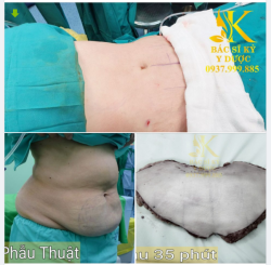 HÚT MỠ- SIẾT EO- BÓP CƠ