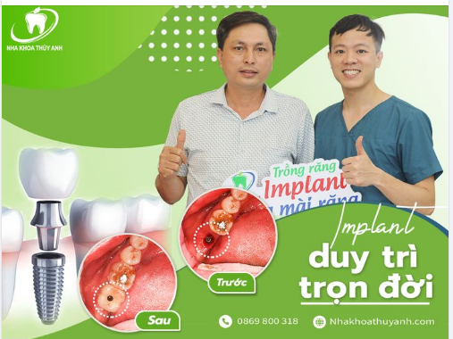IMPLANT KHÔNG MÀI RĂNG TRỌN GÓI CHỈ TỪ 6,9 TRIỆU