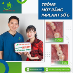 IMPLANT NHA KHOA - BỀN - ĐẸP- TIẾT KIỆM - AN TOÀN
