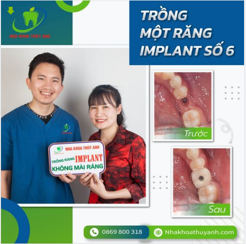 IMPLANT NHA KHOA - BỀN - ĐẸP- TIẾT KIỆM - AN TOÀN