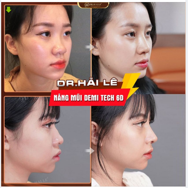 Kết quả "ai nhìn cũng mê" chỉ sau 10 ngày Nâng mũi Demi Tech 6D