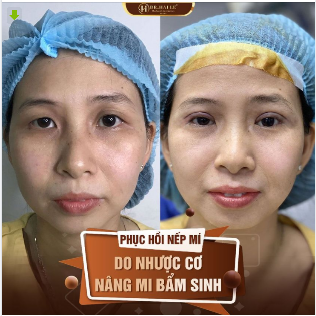 KẾT QUẢ CẮT MÍ - CHỈNH HÌNH NHƯỢC CƠ