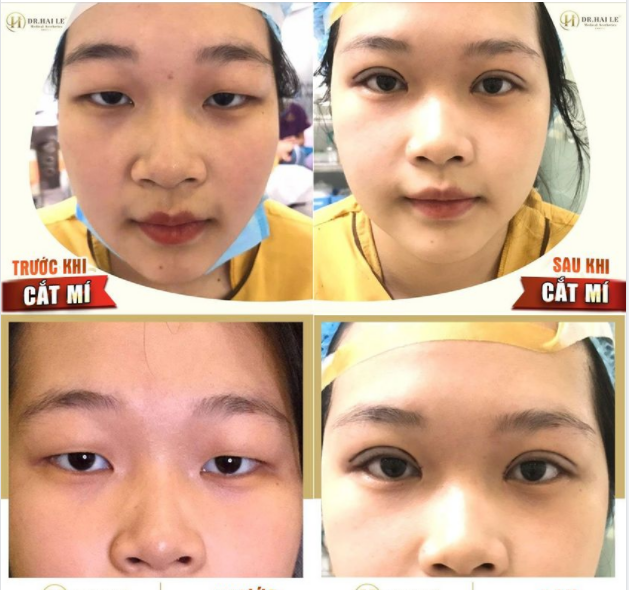KẾT QUẢ CẮT MÍ TẠI DR.HẢI LÊ Đep xuất sắc phải không cả nhà?
