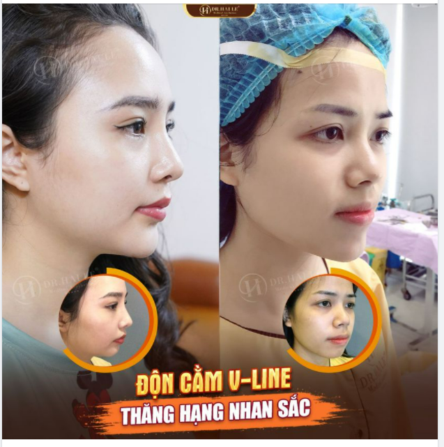 KẾT QUẢ ĐỘN CẰM V-LINE - TỰ TIN VỚI PHIÊN BẢN ĐẸP NHẤT CỦA CHÍNH MÌNH.!!