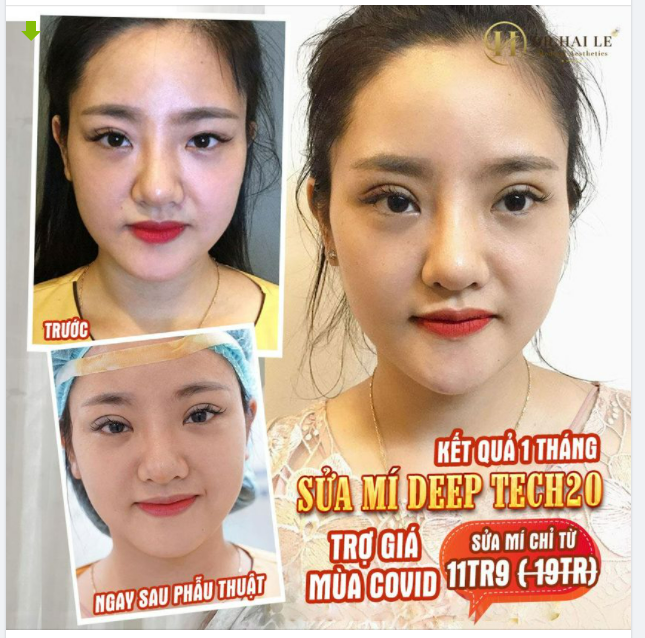 KẾT QUẢ MỸ MÃN SAU 10 NGÀY SỬA MÍ DEEP TECH20