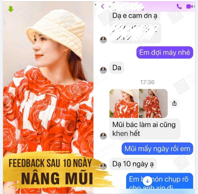 KẾT QUẢ NÂNG MŨI SAU 10 NGÀY