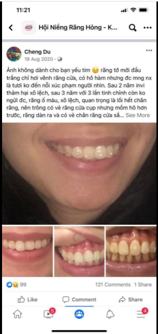 Kết quả niềng răng Invisalign được quyết định bởi yếu tố nào
