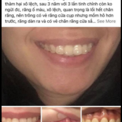 Kết quả niềng răng Invisalign được quyết định bởi yếu tố nào