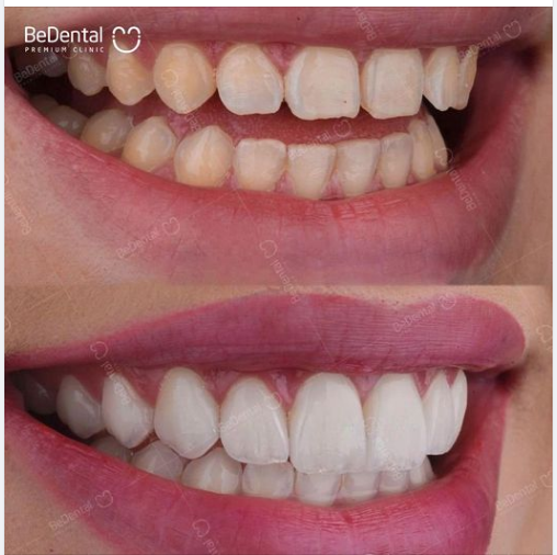 Kết quả phục hình răng sứ cho hàm răng xỉn màu đã từng tẩy trắng nhiều lần nhưng không bật tone