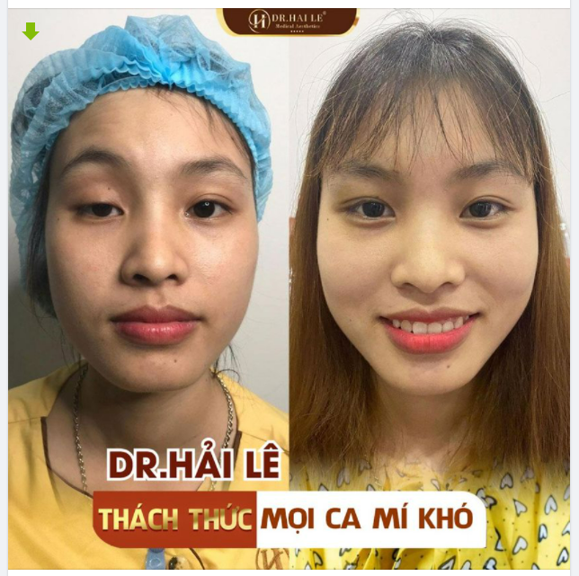 KẾT QUẢ SAU 60 PHÚT SỬA LẠI CA MÍ KHÓ - CHỈNH HÌNH NHƯỢC CƠ