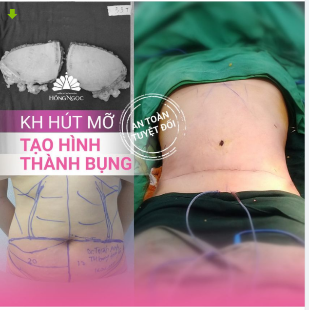 KẾT QUẢ SAU HÚT MỠ TẠO HÌNH THÀNH BỤNG HỒNG NGỌC
