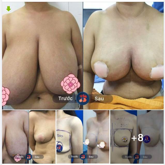 Kết quả sau NÂNG NGỰC kiến tạo đường cong hoàn hảo cho các chị em