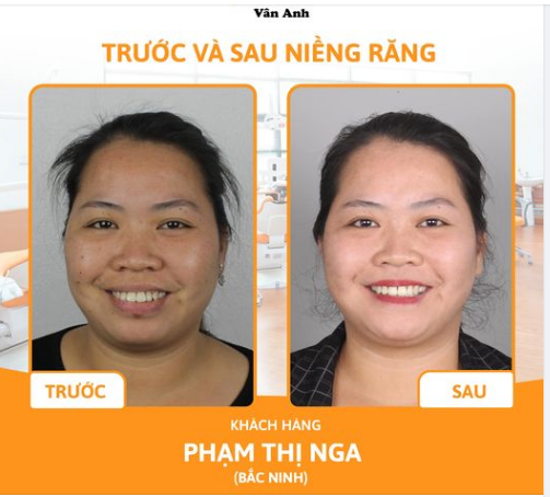 KẾT THÚC HÀNH TRÌNH NIỀNG RĂNG BẰNG MỘT NỤ CƯỜI TỰ TIN
