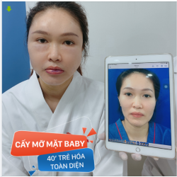 KH cấy mỡ mặt xong Như 2 người xa lạ