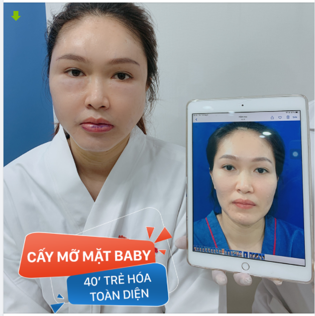 KH cấy mỡ mặt xong Như 2 người xa lạ