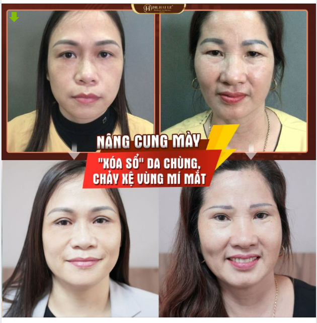 KH trước đây chưa một lần nghĩ mình sẽ thẩm mỹ, thế nhưng đã quyết định Nâng cung mày trong vòng một nốt nhạc