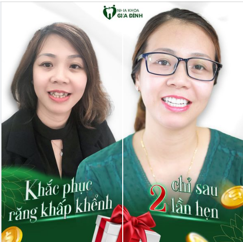 KHẮC BIỆT HOÀN TOÀN SAU KHI THẨM MỸ RĂNG SỨ CAO CẤP