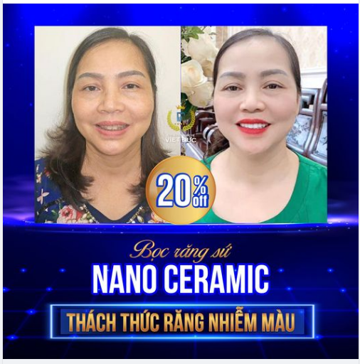 Khắc phục dứt điểm sau 2 ngày bọc răng sứ Tiêu chuẩn Đức