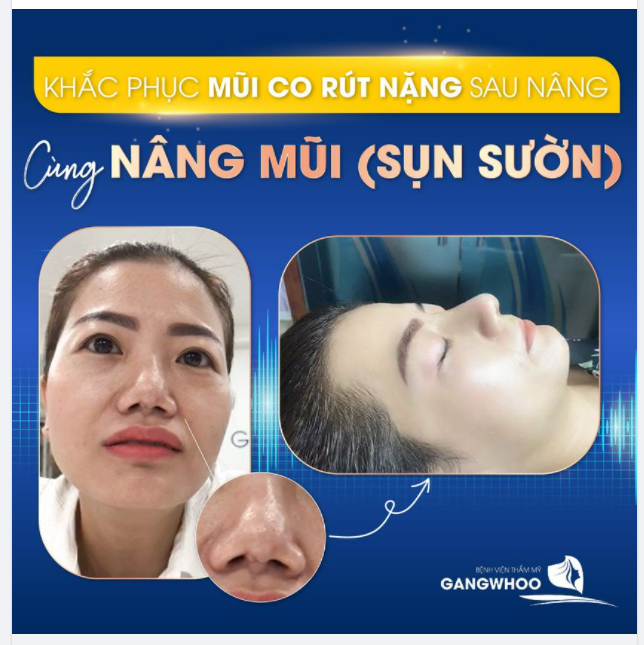 KHẮC PHỤC MŨI CO RÚT NẶNG SAU NÂNG CÙNG NÂNG MŨI (SỤN SƯỜN)
