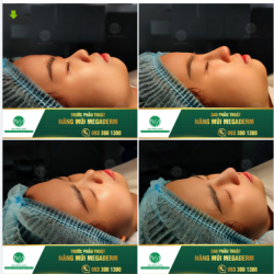 KHẮC PHỤC MŨI THẤP - KHỞI SẮC DIỆN MẠO