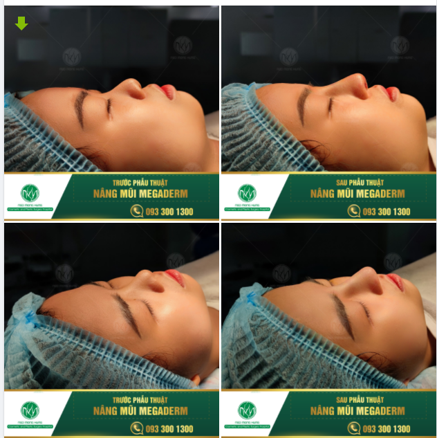 KHẮC PHỤC MŨI THẤP - KHỞI SẮC DIỆN MẠO