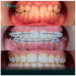 KHẮC PHỤC TÌNH TRẠNG KHỚP CẮN NGƯỢC CHO TRẺ 12 TUỔI