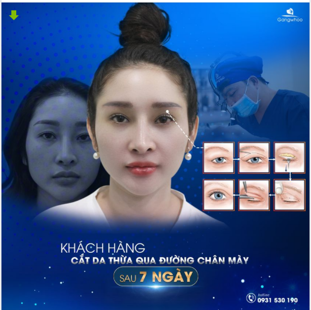 KHẮC PHỤC VẤN ĐỀ LÃO HOÁ MẮT CHỈ TRONG 7 NGÀY