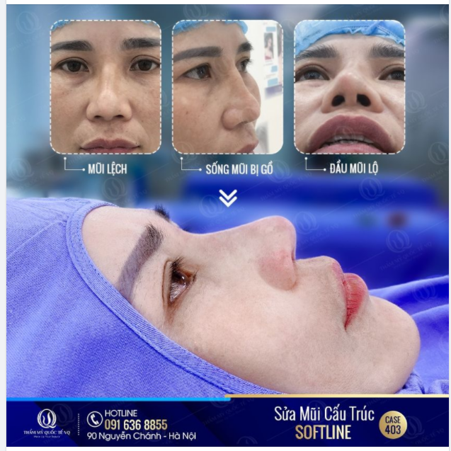 Khách hàng đã từng thẩm mỹ mũi tại 1 cơ sở khác nhưng bị hỏng rất nghiêm trọng: Mũi lệch sống, sống mũi gồ, đầu mũi lộ, mũi viêm nặng.