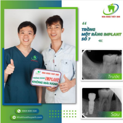KHÁCH HÀNG MONG MUỐN ĐIỀU GÌ KHI TRỒNG RĂNG IMPLANT