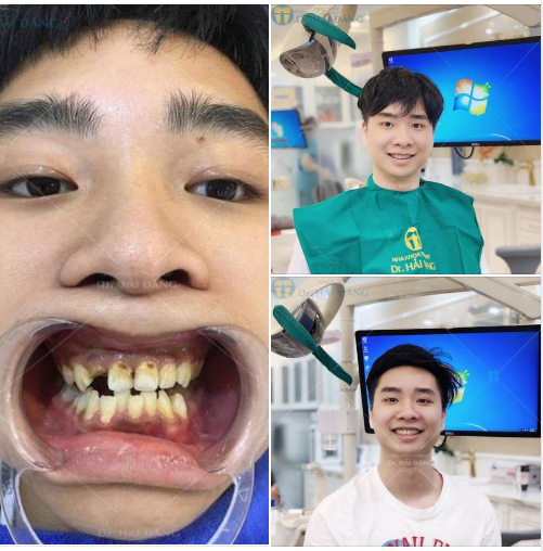 Khách hàng : Thanh Tùng ( Quảng Ninh)  Với tình trạng ban đầu răng khấp khểnh