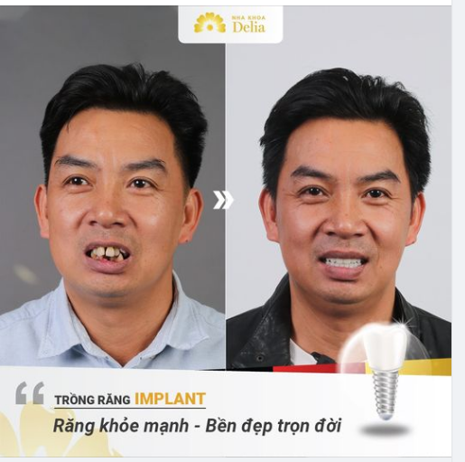 Khách hàng thông thái: “Trồng răng Implant hồi sinh hàm răng khỏe mạnh”