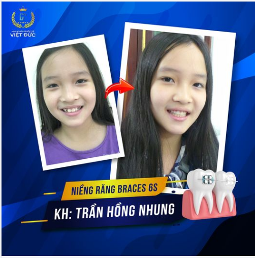 Khách hàng: Trần Hồng Nhung luôn cảm thấy tự ti với hàm răng hô, khấp khểnh, khớp cắn sai lệch, hình thể răng dài ngắn.