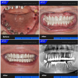 Khách hàng trên 50 tuổi đến Peace Dentistry