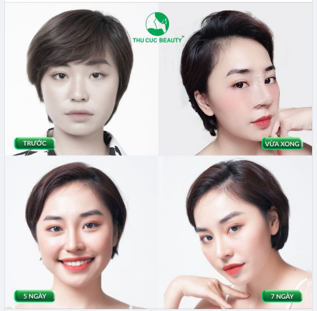 KHÁM PHÁ BÍ QUYẾT SỞ HỮU MŨI ĐẸP CHUẨN TỶ LỆ VÀNG NHANH HIỆU QUẢ NHẤT