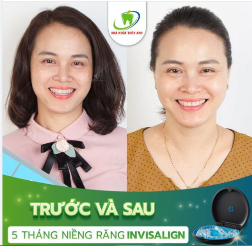 KHAY NIỀNG TRONG SUỐT - NỤ CƯỜI XUYÊN SUỐT