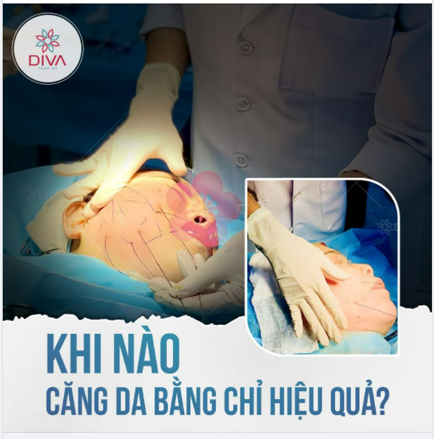 KHI NÀO CĂNG CHỈ DA MẶT HIỆU QUẢ?