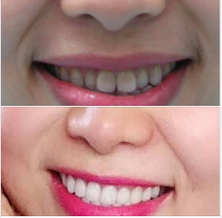 Khi nào thì răng sứ đẹp