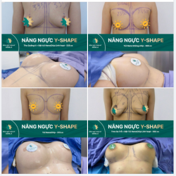 Khoe nhẹ với cả nhà các siêu phẩm được tạo nên bởi Công nghệ Nâng Ngực Y-Shape và đội ngũ Bác sĩ dày dặn kinh nghiệm thuộc Hiệp hội Thẩm mỹ Hàn Quốc.