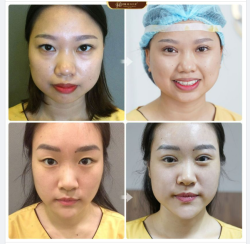 Khoe với cả nhà kết quả Cắt mí tại Dr.Hải Lê