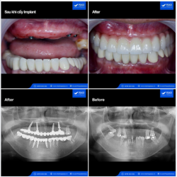 Khôi phục trọn vẹn chức năng ăn nhai và thẩm mỹ cho khách hàng lớn tuổi